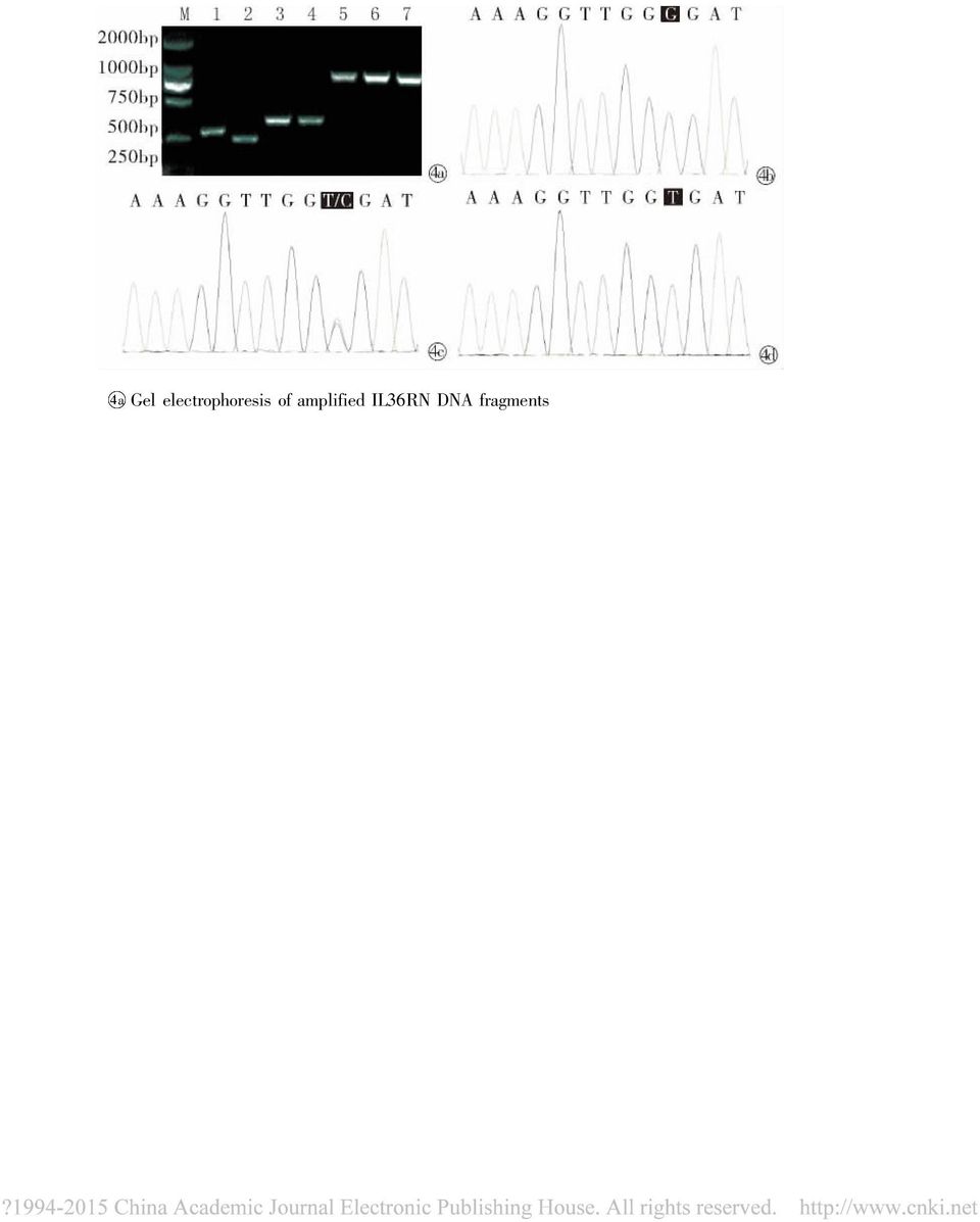 4 4 PCR Gel electrophoresis and PCR sequencing of amplified IL36RN DNA fragments PsA Rieter IL-1Ra IL1RN Piepkorn 11 1 25 GPP A 4 A A TNF-α IL36RN c. 115 + 6T > C DITRA IL36RN c.