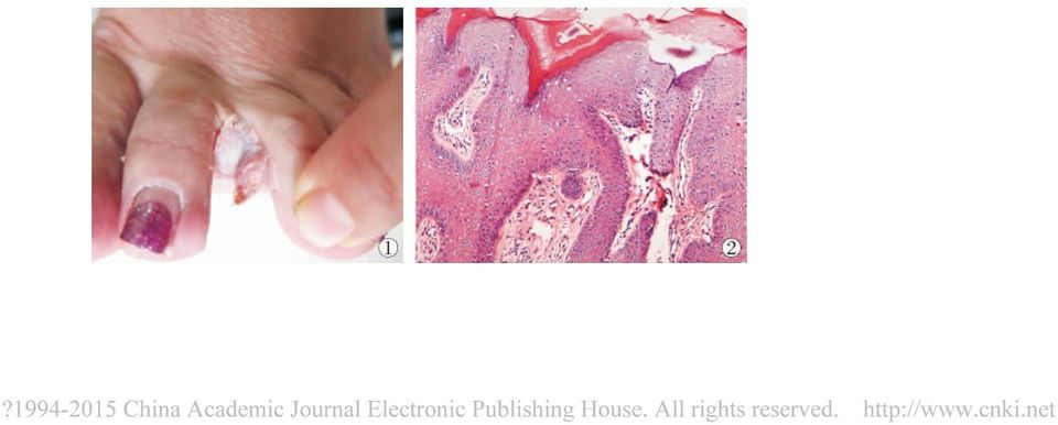 Mutations in IL36RN / IL1F5 are associated with the severe episodic inflammatory skin disease known as generalized pustular psoriasis J. Am J Hum Genet 2011 89 3 432-437.
