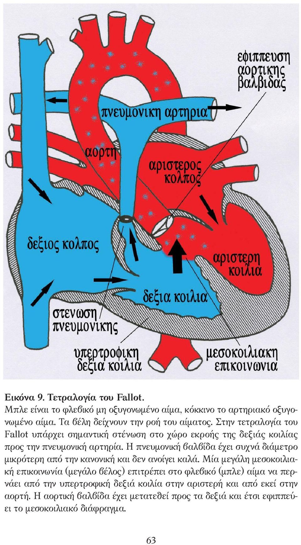 Η πνευµονική βαλβίδα έχει συχνά διάµετρο µικρότερη από την κανονική και δεν ανοίγει καλά.