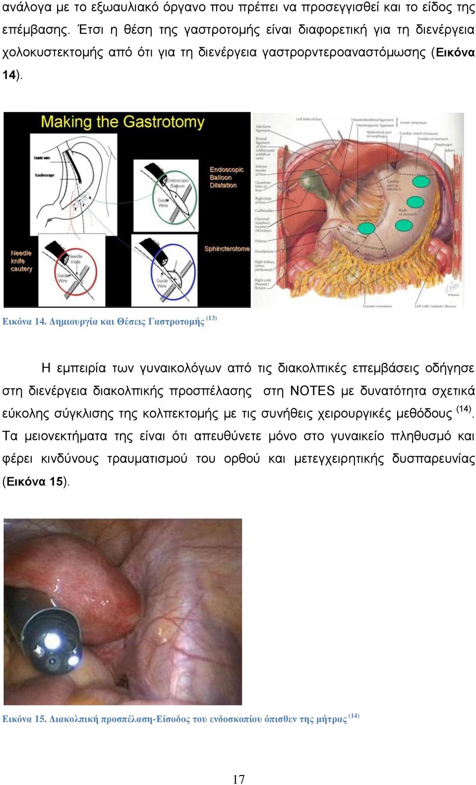 Γεκηνπξγία θαη Θέζεηο Γαζηξνηνκήο (13) Ζ εκπεηξία ησλ γπλαηθνιφγσλ απφ ηηο δηαθνιπηθέο επεκβάζεηο νδήγεζε ζηε δηελέξγεηα δηαθνιπηθήο πξνζπέιαζεο ζηε NOTES κε δπλαηφηεηα ζρεηηθά εχθνιεο