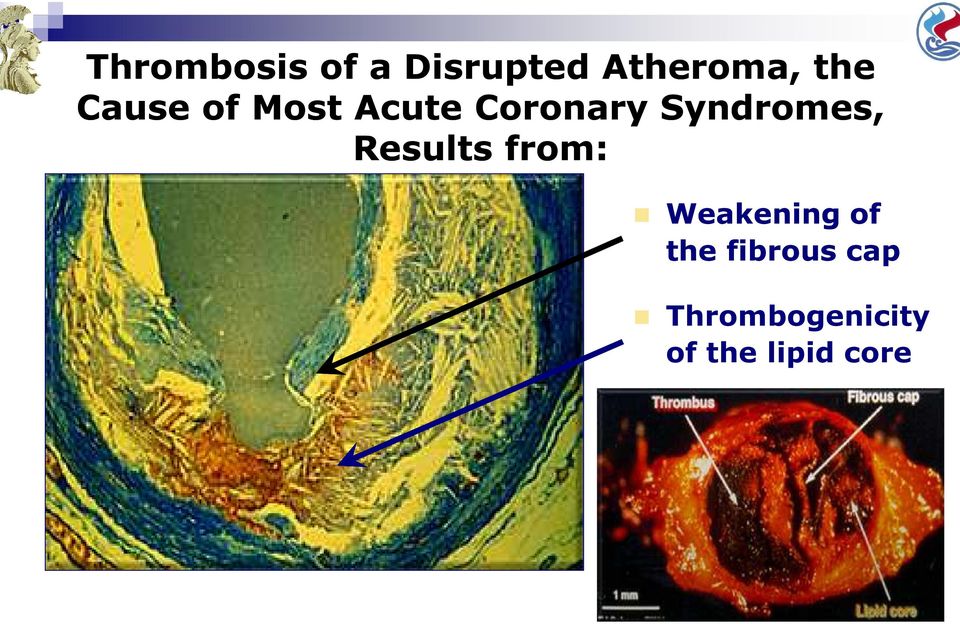 Weakening of the fibrous cap Thrombogenicity of the