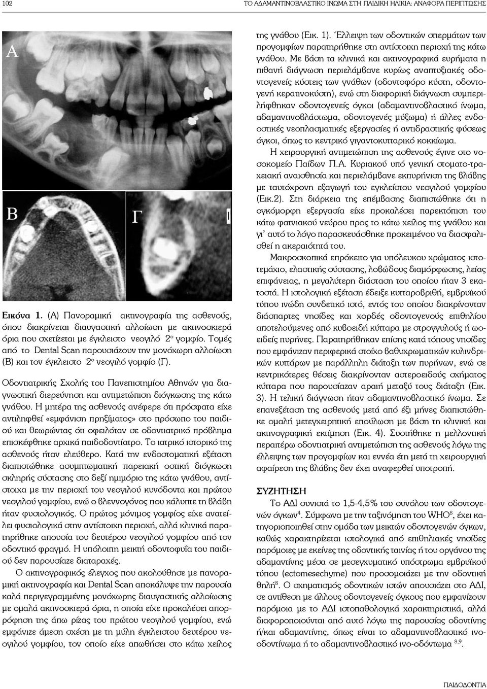 Τομές από το Dental Scan παρουσιάζουν την μονόχωρη αλλοίωση (Β) και τον έγκλειστο 2 ο νεογιλό γομφίο (Γ).