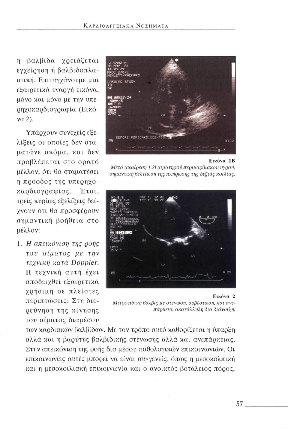 Έτσι, τρείς κυρίως εξελίξεις δείχνουν ότι θα προσφέρουν σημαντική βοήθεια στο μέλλον: Εικόνα IB Μετά αφαίρεση 1.21 αιματηρού περικαρδιακού υγρού, σημαντική βελτίωση της πλήρωσης της δεξιάς κοιλίας. 1. Η απεικόνιση της ροής τον αίματος με την τεχνική κατά Doppler.
