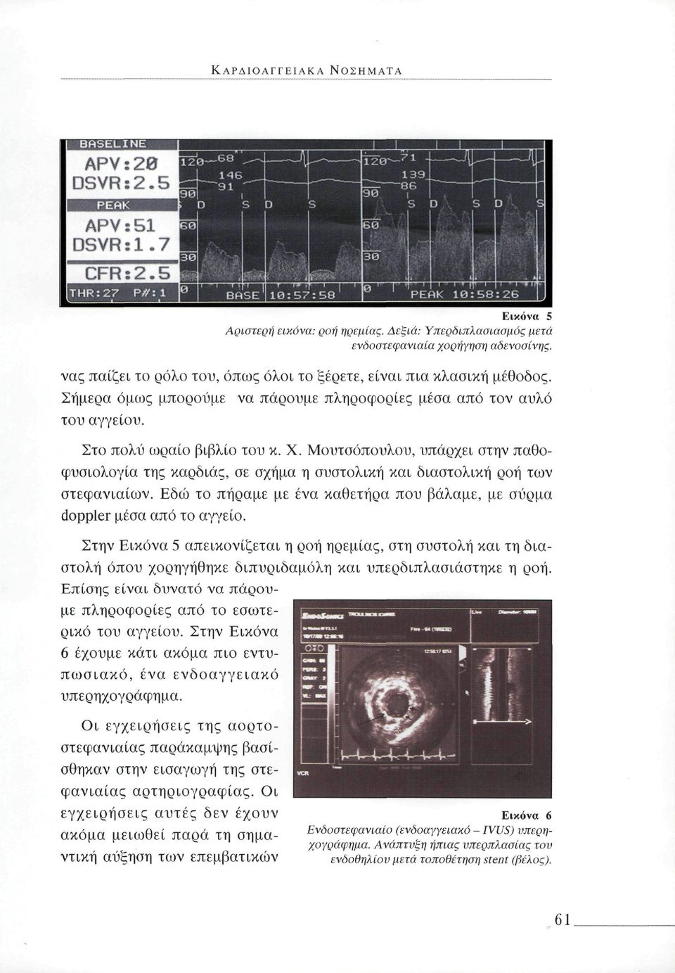 Μουτσόπουλου, υπάρχει στην παθοφυσιολογία της καρδιάς, σε σχήμα η συστολική και διαστολική ροή των στεφανιαίων. Εδώ το πήραμε με ένα καθετήρα που βάλαμε, με σύρμα doppler μέσα από το αγγείο.