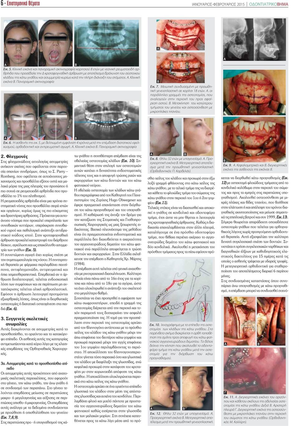 ασυμμετρία κυρίως κατά την πλήρη διάνοιξη του στόματος. Α. Κλινική εικόνα Β. Πανοραμική ακτινογραφία Β Εικ. 7. Μειωτική συνδυασμένη με προωθητική γενειοπλαστική σε κορίτσι 18 ετών. Α. οι παράλληλες γραμμές της οστεοτομίας, που αναλογούν στην περιοχή του προς αφαίρεση οστού.