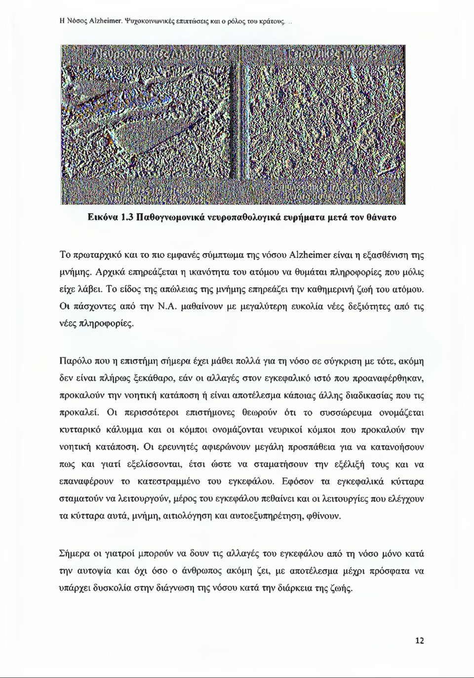 Αρχικά επηρεάζεται η ικανότητα του ατόμου να θυμάται πληροφορίες που μόλις είχε λάβει. Το είδος της απώλειας της μνήμης επηρεάζει την καθημερινή ζωή του ατόμου. Οι πάσχοντες από την Ν.Α. μαθαίνουν με μεγαλύτερη ευκολία νέες δεξιότητες από τις νέες πληροφορίες.