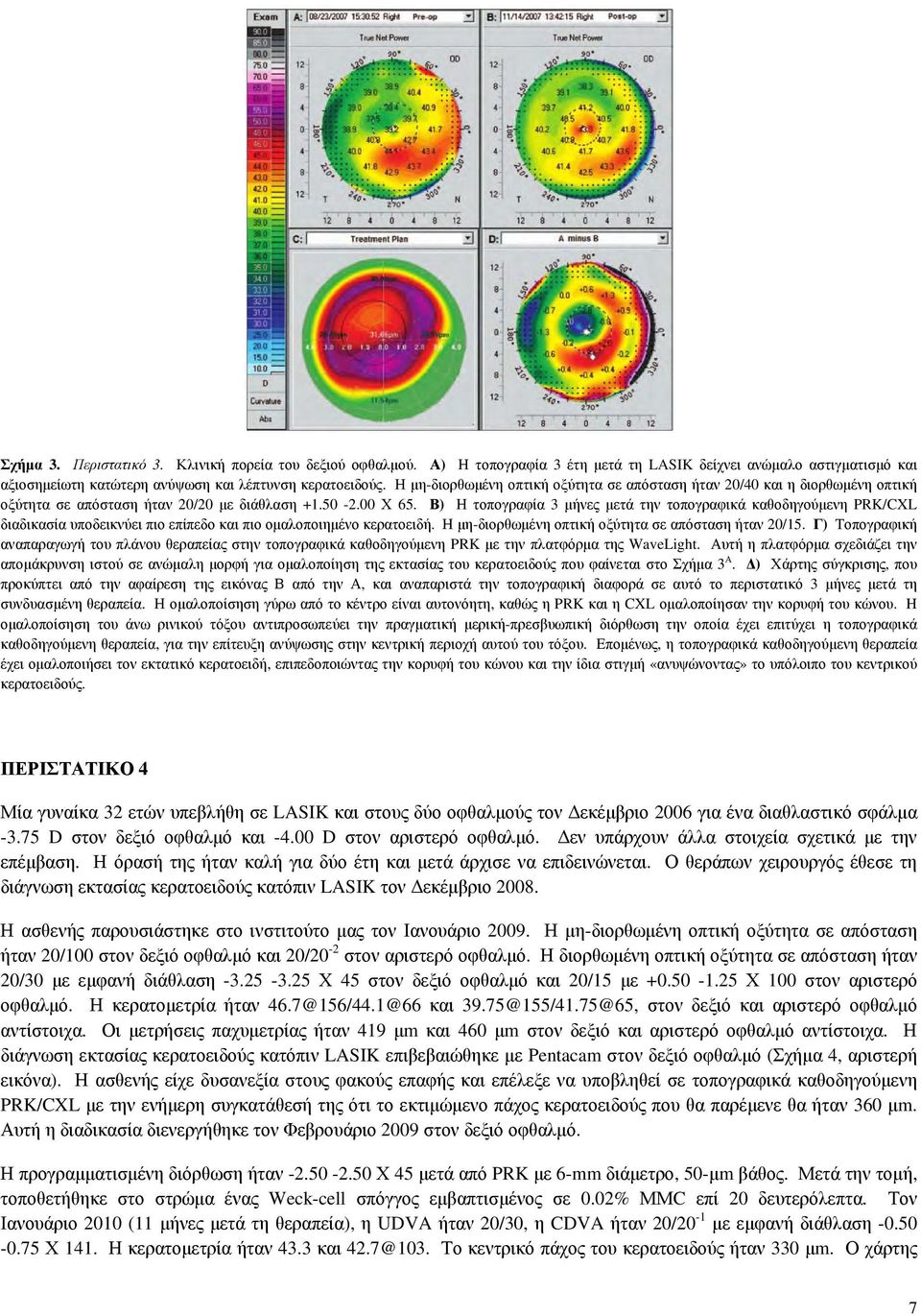 Β) Η τοπογραφία 3 μήνες μετά την τοπογραφικά καθοδηγούμενη PRK/CXL διαδικασία υποδεικνύει πιο επίπεδο και πιο ομαλοποιημένο κερατοειδή. Η μη-διορθωμένη οπτική οξύτητα σε απόσταση ήταν 20/15.
