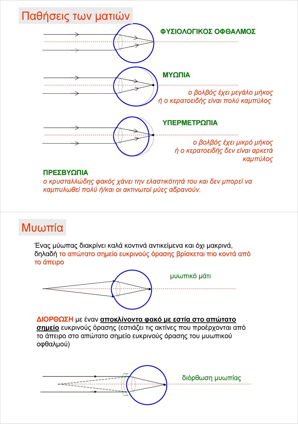 Μυωί Ένς μύως δικρίνει κλά κοντινά ντικείμεν κι όχι μκρινά, δηλδή το ώττο σημείο ευκρινούς όρσης βρίσκετι ιο κοντά ό το άειρο μυωικό μάτι ΔΙΟΡΘΩΣΗ με
