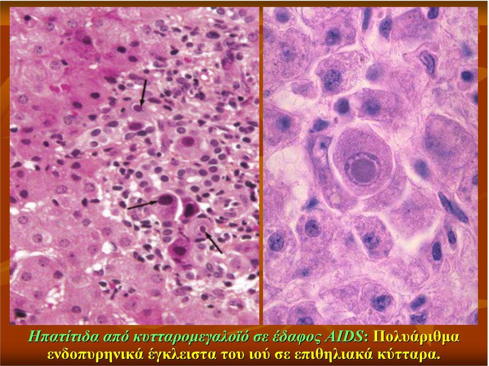 AIDS: Πολυάριθµα