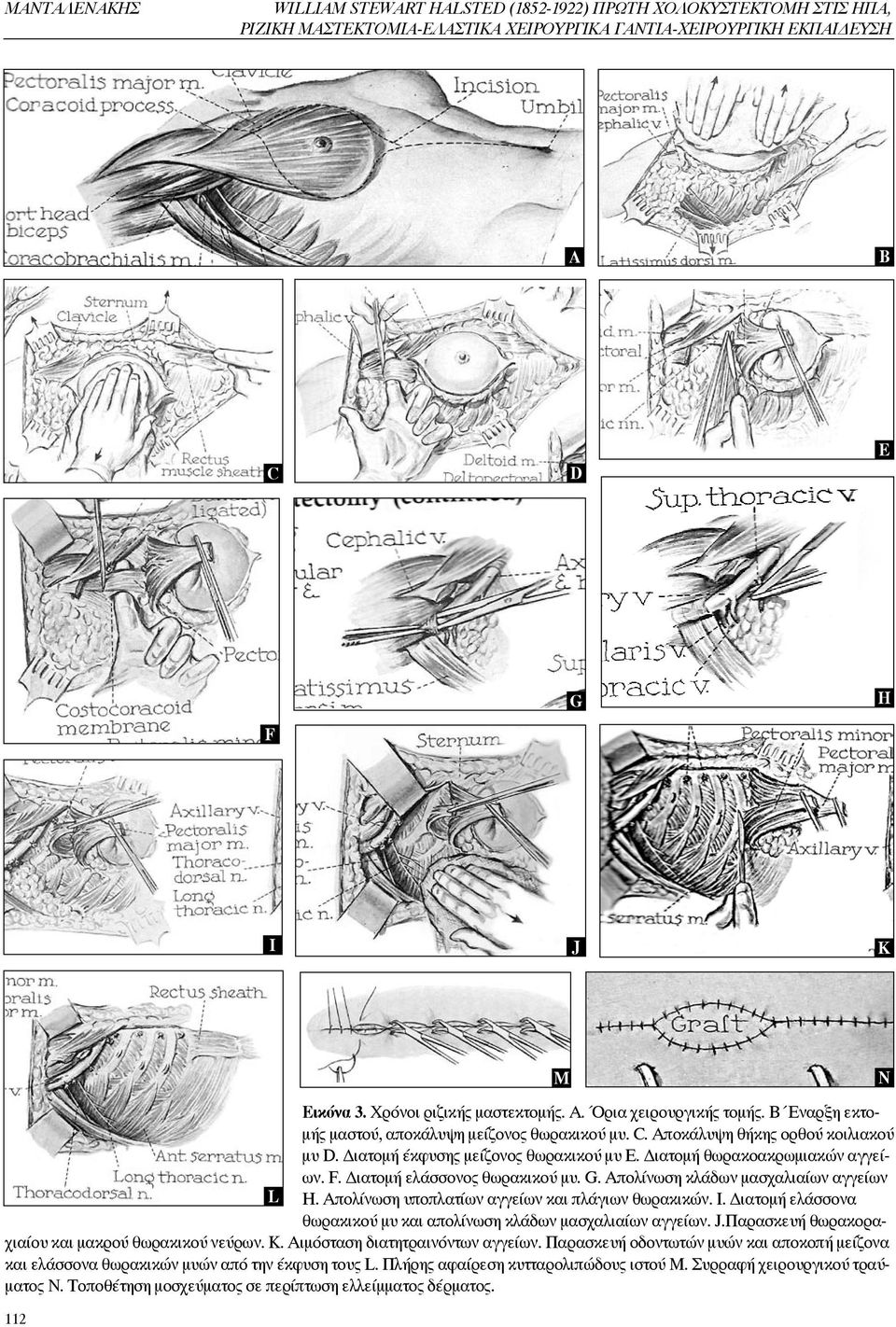 Διατομή θωρακοακρωμιακών αγγείων. F. Διατομή ελάσσονος θωρακικού μυ. G. Απολίνωση κλάδων μασχαλιαίων αγγείων L H. Απολίνωση υποπλατίων αγγείων και πλάγιων θωρακικών. I.