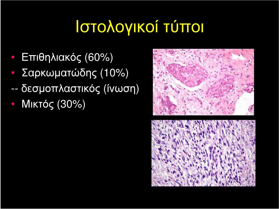 Σαρκωματώδης (10%) --