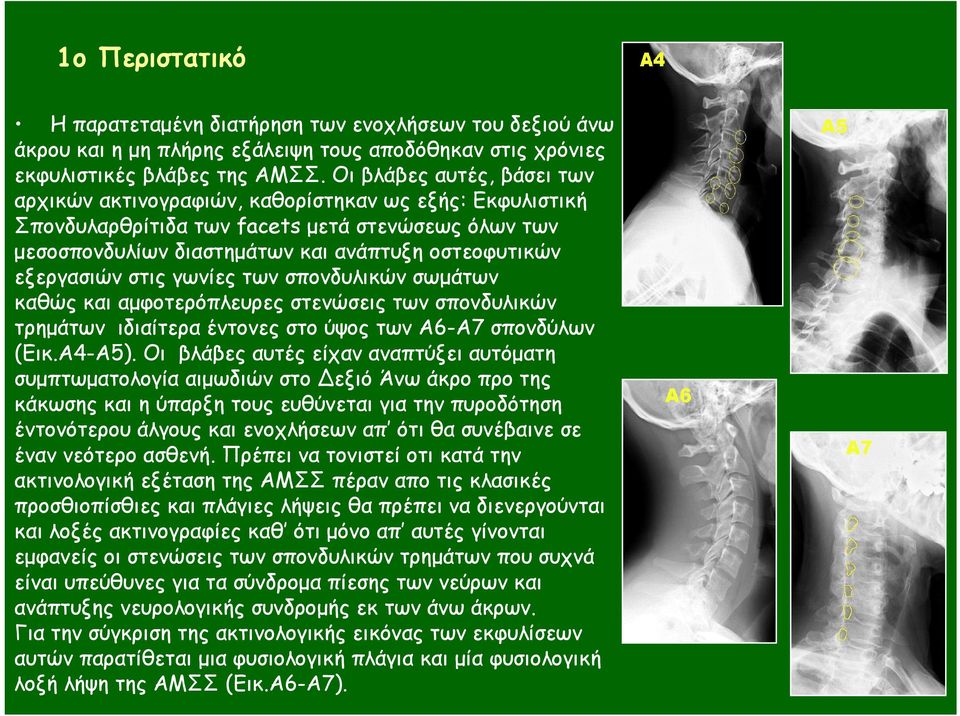 στις γωνίες των σπονδυλικών σωµάτων καθώς και αµφοτερόπλευρες στενώσεις των σπονδυλικών τρηµάτων ιδιαίτερα έντονες στο ύψος των Α6-Α7 σπονδύλων (Εικ.Α4-Α5).