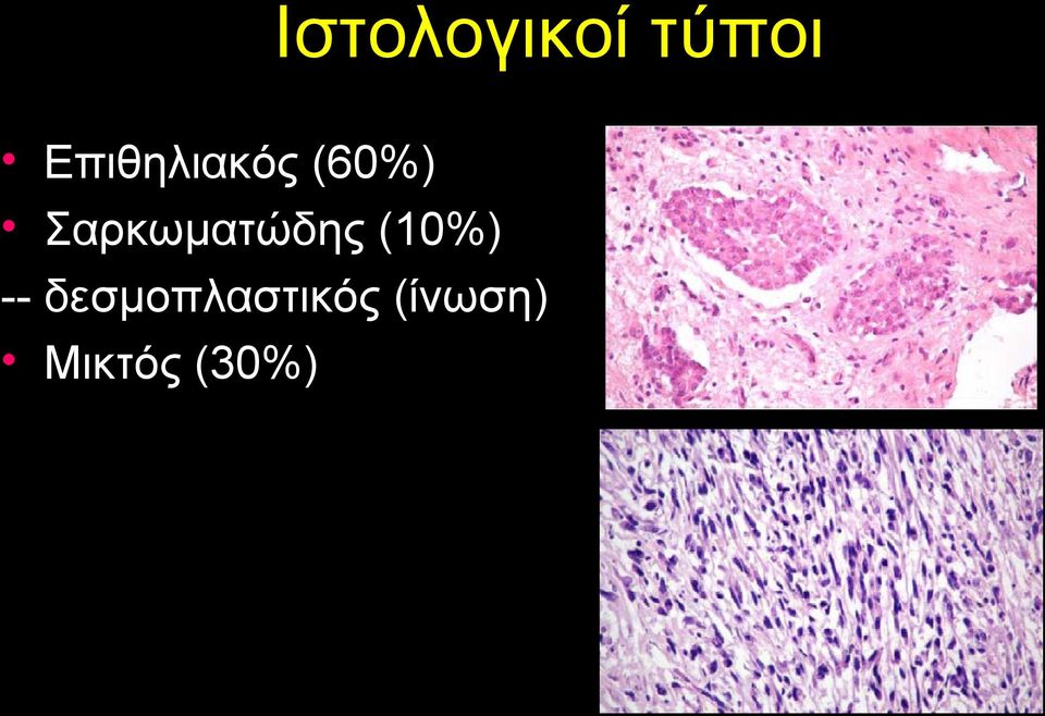 Σαρκωματώδης (10%) --