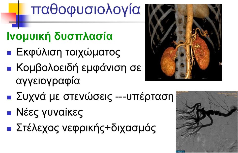 σε αγγειογραφία Συχνά με στενώσεις