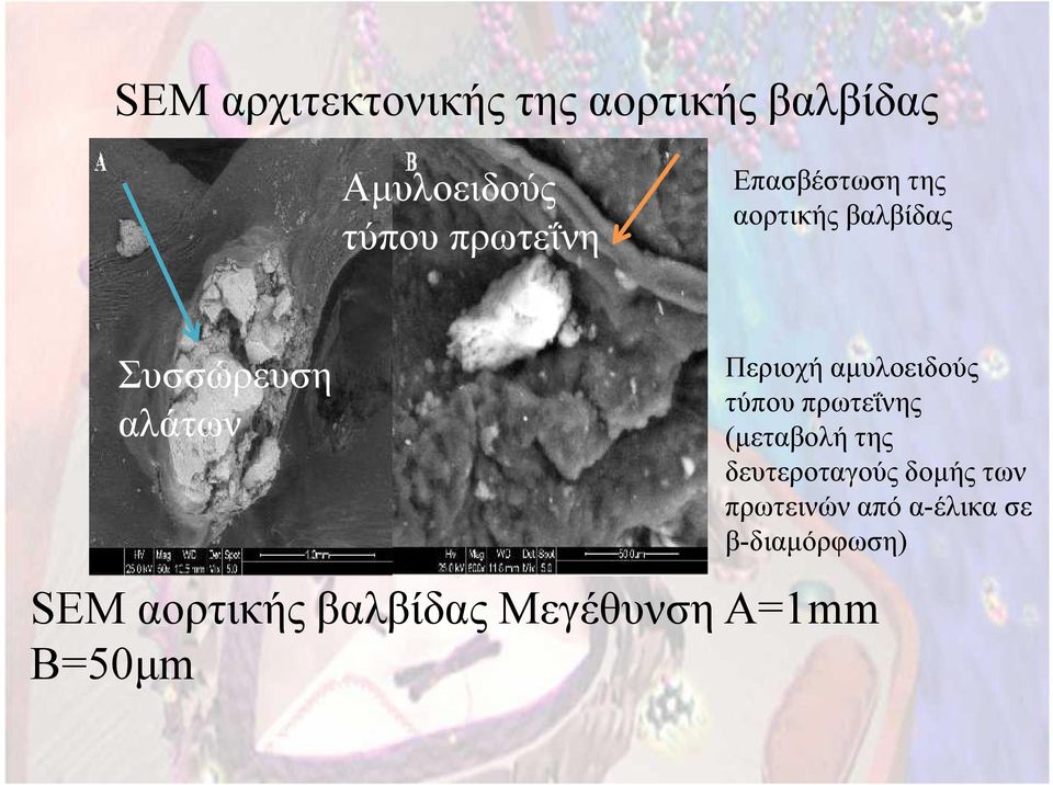 αμυλοειδούς τύπου πρωτεΐνης (μεταβολή της δευτεροταγούς δομής των