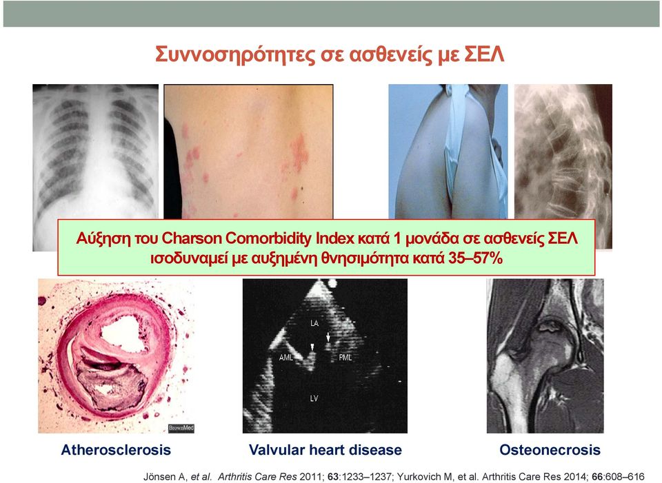 Osteoporosis Atherosclerosis Valvular heart disease Osteonecrosis Jönsen A, et al.