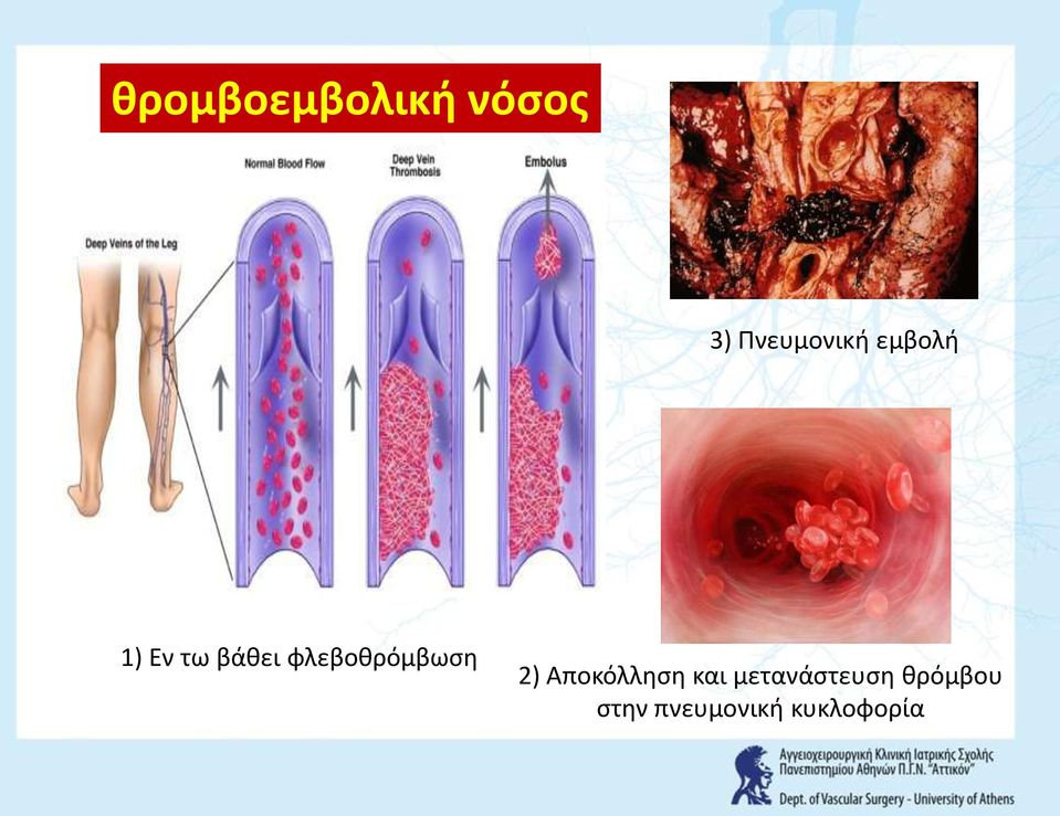 φλεβοκρόμβωςθ 2) Αποκόλλθςθ και