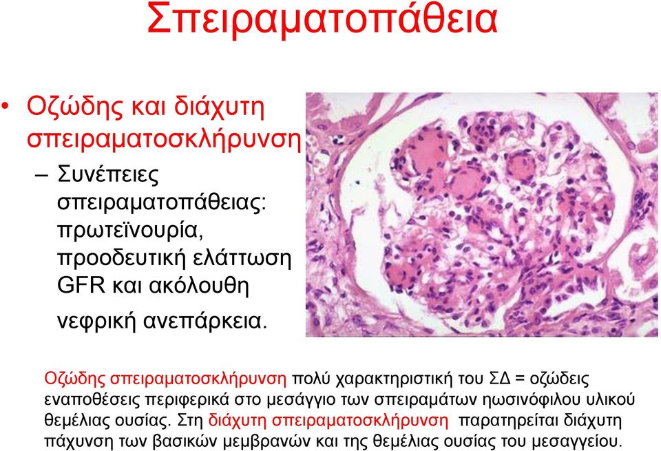 Οδώδεο ζπεηξακαηνζθιήξπλζε πνιύ ραξαθηεξηζηηθή ηνπ ΣΓ = νδώδεηο ελαπνζέζεηο πεξηθεξηθά ζην κεζάγγην ησλ