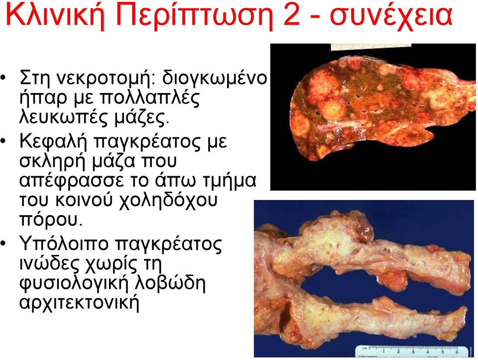 Κεθαιή παγθξέαηνο κε ζθιεξή κάδα πνπ απέθξαζζε ην άπσ ηκήκα
