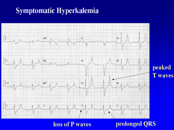 EKG