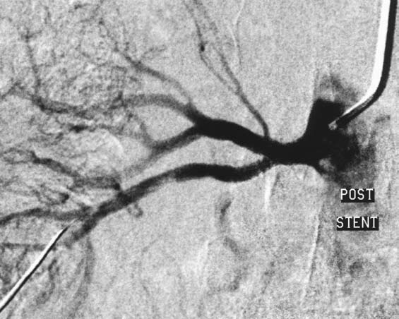 Αγγειοπλαστική και stent σε