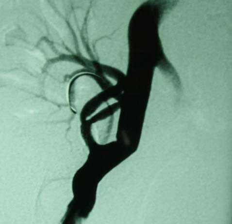 (a) Transplant renal artery stenosis at the bifurcation, affecting mostly the inner ramus. (b).