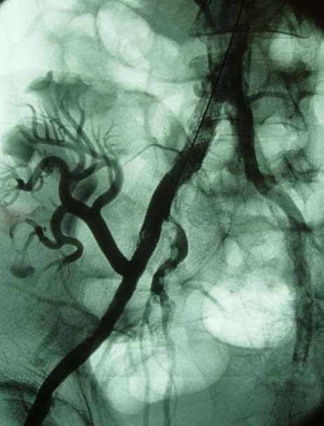 Right: Common and external iliac artery stenoses provoking claudication and renal