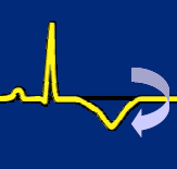 ST - ενζυμα/tn +ενζυμα/tn ST Elevation ΟΣΣ