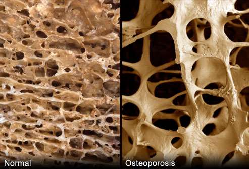 αντοχής οστών: Ρυθμός σχηματισμού < ρυθμός απορρόφησης Διαταραχές μικροαρχιτεκτονικής οστών Διαταραχές