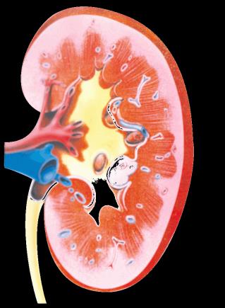 Περιφερική αγγειοπάθεια Renal failure