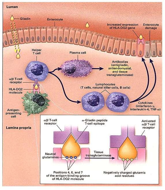 1. εξωτερικός παράγοντας (γλουτένη) 2. μεταβολές στη διαπερατότητα του εντερικού βλεννογόνου (zonulin) 3. ενζυμική τροποποίηση της γλουτένης (TG) 4. αναγνώριση από το σύστημα HLA 5.