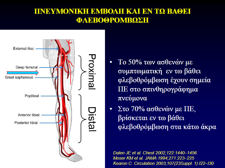 Eν Τω Βάθει Φλεβοθρόμβωση (ΕΒΦ) 50% ασθενών με συμπτωματική ΕΦΒ, χωρίς συμπτώματα ΠΕ, έχουν θρόμβους στην πνευμονική κυκλοφορία ΕΒΦ ανευρίσκεται