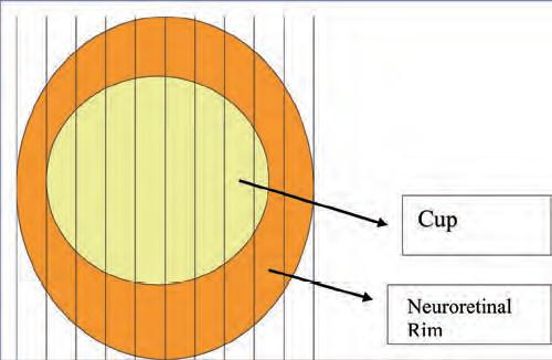 Εικόνα 9. Σχηματική απεικόνιση λόγου κοίλανσης/θηλής - Cup/disc ratio (C/D) 22 Ο υπολογισμός του C/D είναι μία αδρή μέθοδος εκτίμησης με περισσότερο χρησιμοποιούμενη την μέτρηση στον κατακόρυφο άξονα.
