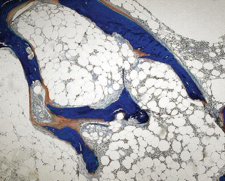 Εικόνα 5 Μικτή μορφή νεφρικής οστεοδυστροφίας. Αυξημένο ποσοστό απορροφητικής δραστηριότητας.συσσώρευση οστυεοειδούς. Στοιχεία μερικής ίνωσης. (τροποποιημένη V.