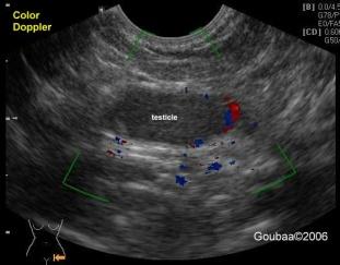 Tasian and Hillary L Copp Diagnostic Performance of Ultrasound in Nonpalpable Cryptorchidism: A Systematic Review and Meta-analysis