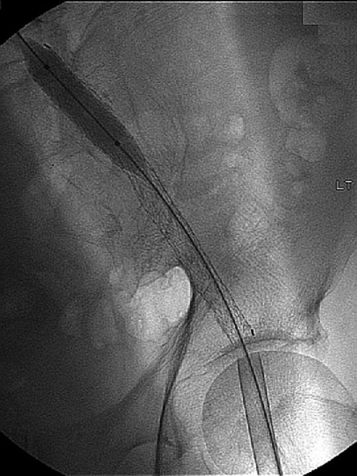 From: Peterson BG, Matsumura JS. Internal endoconduit: An innovative technique to address unfavorable iliac artery anatomy J Vasc Surg 2008; 47:441-445 4β.