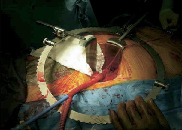 abdominal aortic aneurysm repair J Vasc Surg 2003; 38:459-465 5.