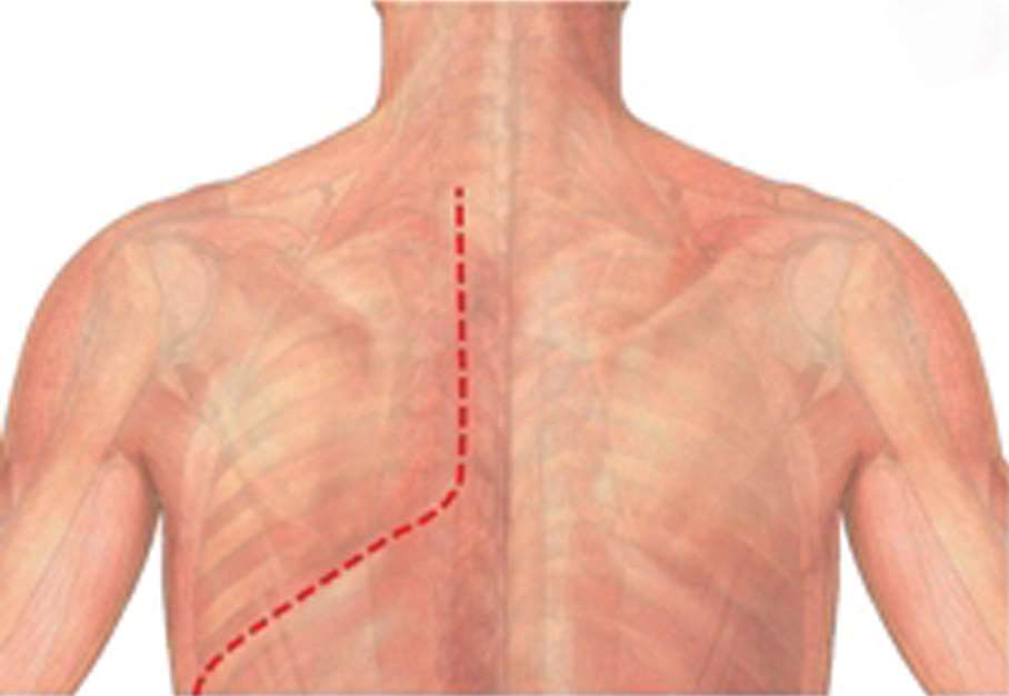 Shaw-Paulson Superior sulcus () tumors: current evidence on diagnosis and radical treatment