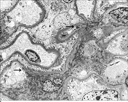 ΣΕΛ τάξης ΙIΙ: Eστιακή - Focal lupus nephritis ΣΕΛ τάξης ΙΙΙ: