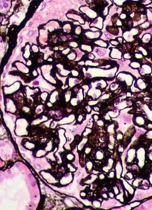 Νεφρίτιδα του ΣΕΛ τάξης V. Xρ. αργύρου Πάχυνση των βασικών μεμβρανών των ενδοσπειραματικών τριχοειδών με ακιδωτική παρυφή της εξωτερικής τους επιφάνειας.