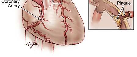 Coronary