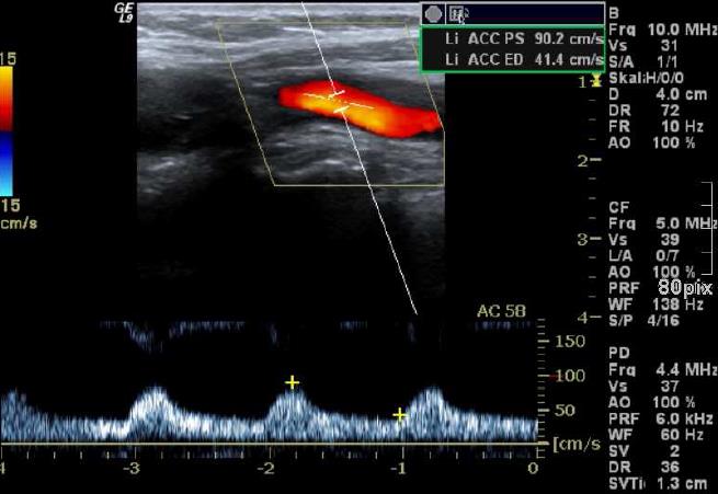 Doppler υπερηχογράφημα(+) Εύκολα
