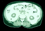 Fat Topography In Type 2 Diabetic Subjects Intramuscular Intrahepatic Subcutaneous