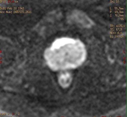 DW MRI