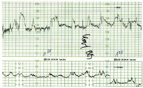 CTG Επιταχύνσεις του καρδιακού ρυθμού Επιτάχυνση: αύξηση του καρδιακού ρυθμού >15 bpm που διαρκεί >15 sec