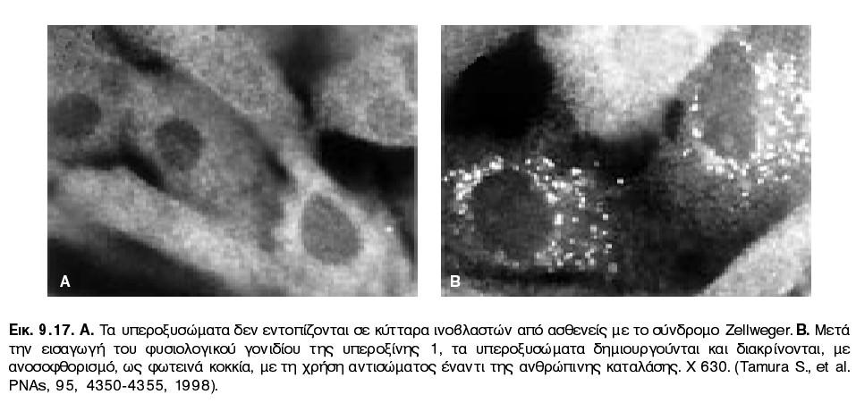 ιστούς Έλλειψη Υ ή ghosts-y Συσσώρευση λιπαρών οξέων μακριάς αλυσίδας (σε ορό και ιστούς) Μεταλλαγές σε