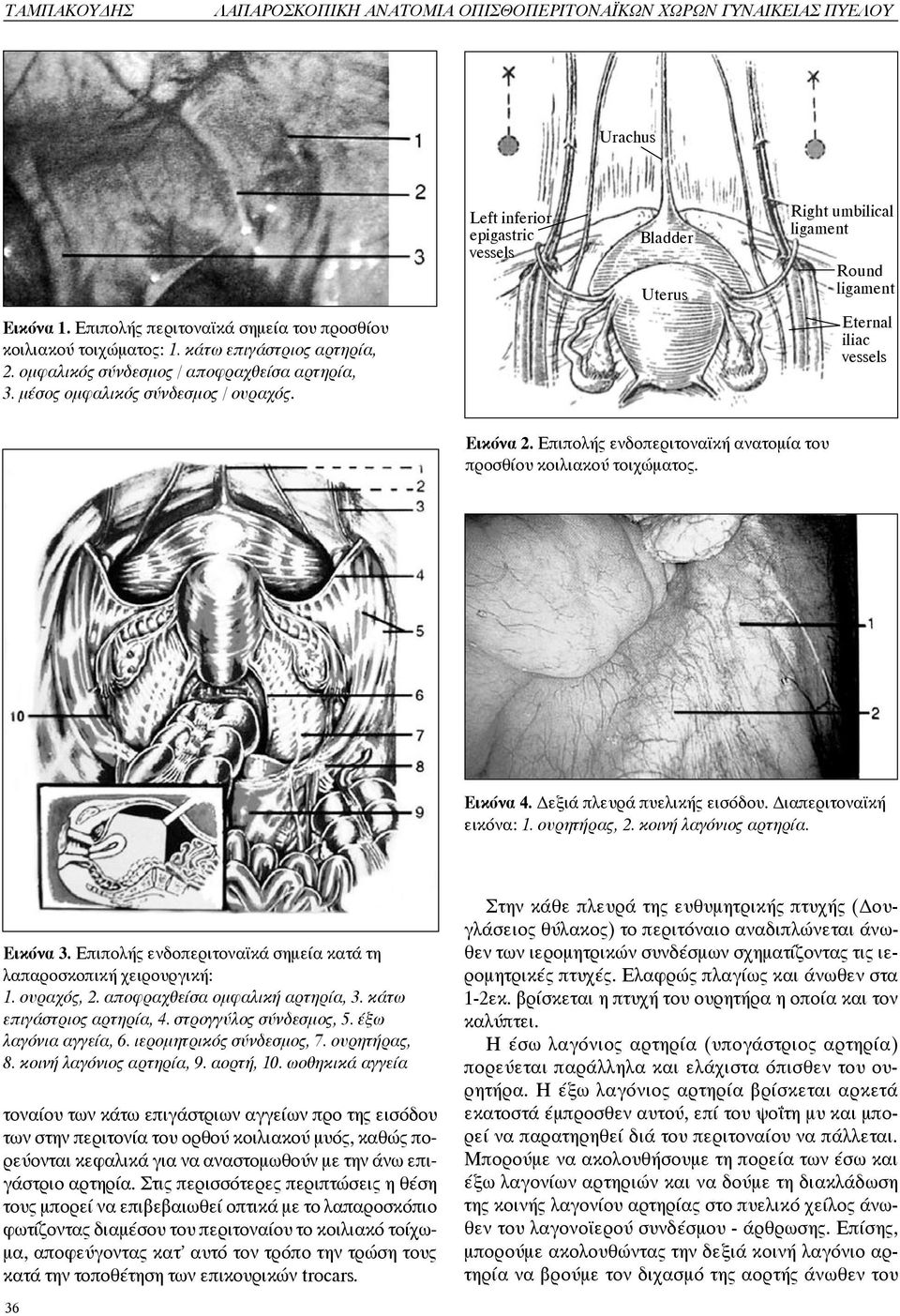 Left inferior epigastric vessels Bladder Uterus Right umbilical ligament Round ligament Eternal iliac vessels Εικόνα 2. Επιπολής ενδοπεριτοναϊκή ανατομία του προσθίου κοιλιακού τοιχώματος. Εικόνα 4.