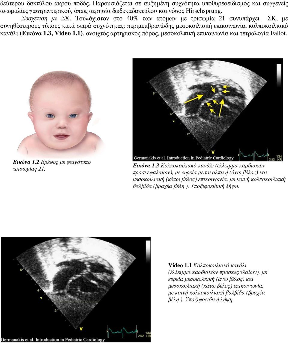 1), ανοιχτός αρτηριακός πόρος, µεσοκολπική επικοινωνία και τετραλογία Fallot. Εικόνα 1.
