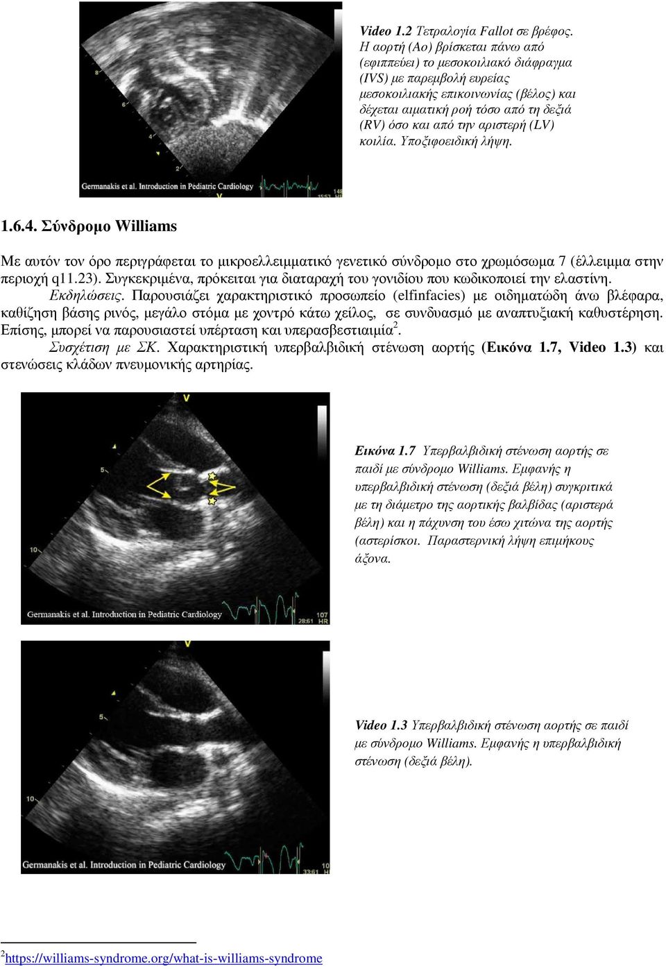 αριστερή (LV) κοιλία. Υποξιφοειδική λήψη. 1.6.4. Σύνδροµο Williams Με αυτόν τον όρο περιγράφεται το µικροελλειµµατικό γενετικό σύνδροµο στο χρωµόσωµα 7 (έλλειµµα στην περιοχή q11.23).