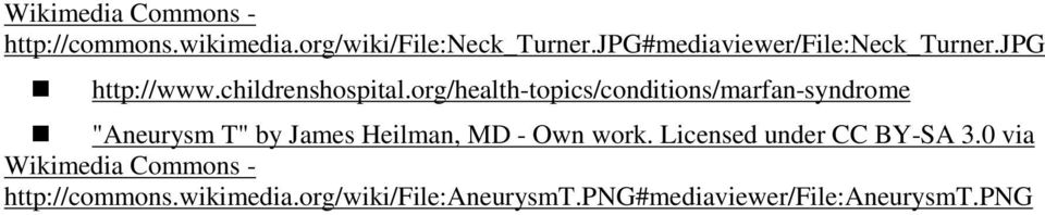 org/health-topics/conditions/marfan-syndrome "Aneurysm T" by James Heilman, MD - Own work.